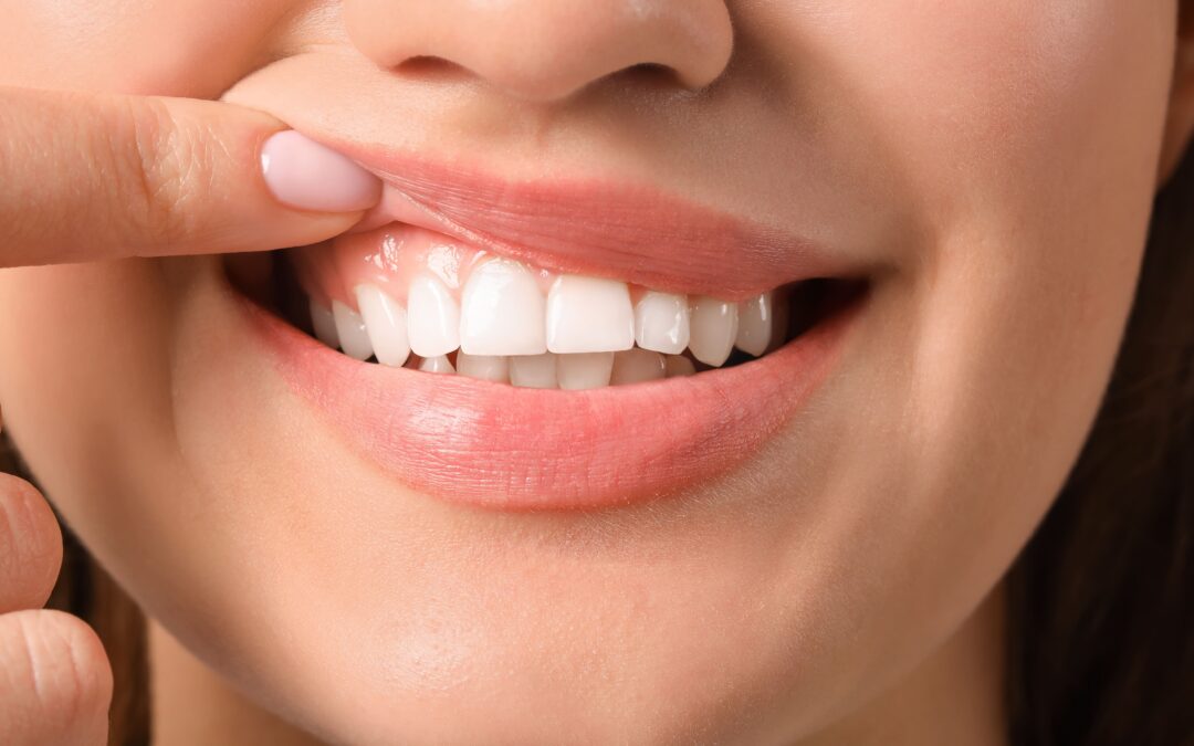 Why Gum Health Matters Before Dental Implants